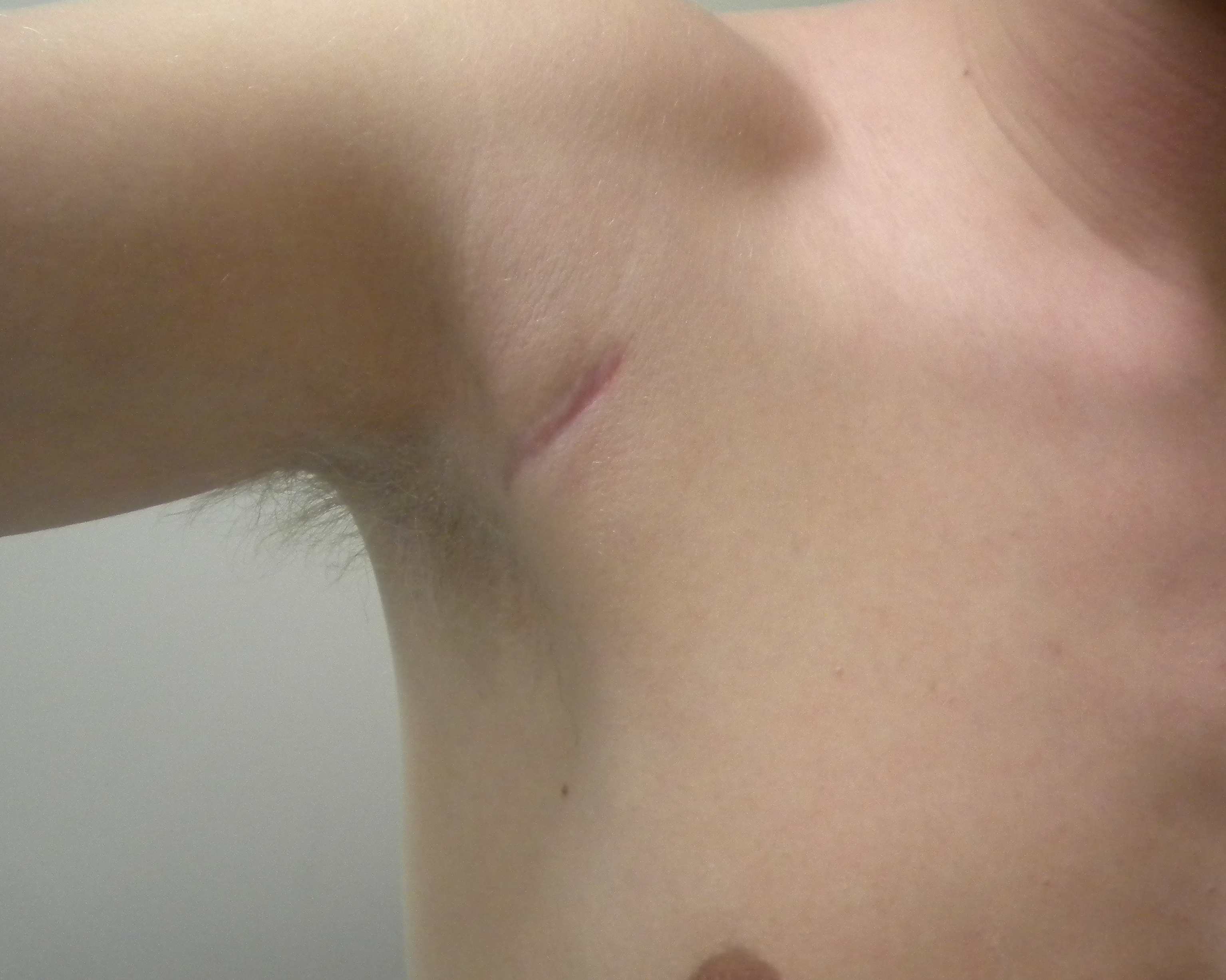 Axillary Incision 2